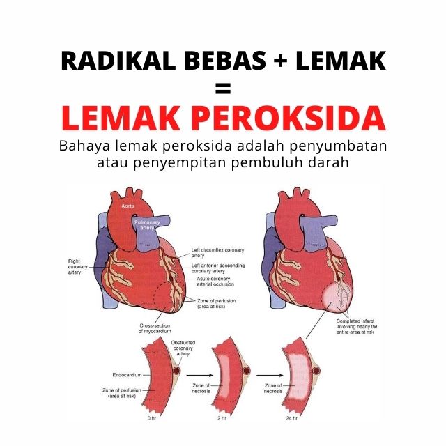 Radikal Bebas